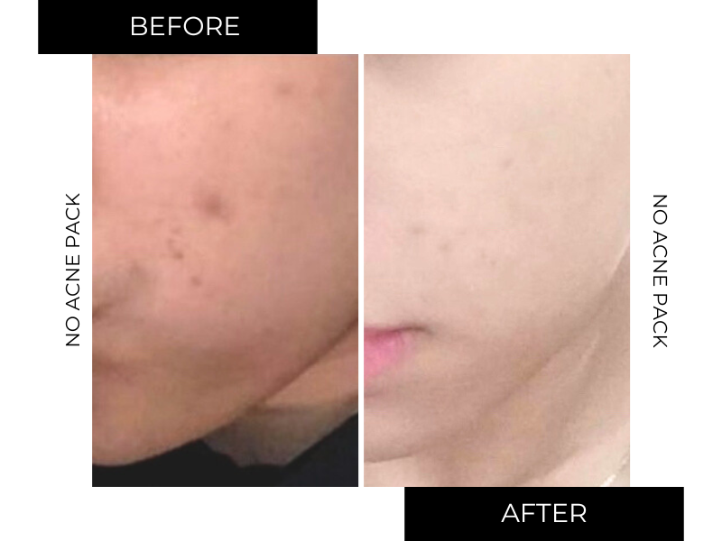 NO-ACNE PACK