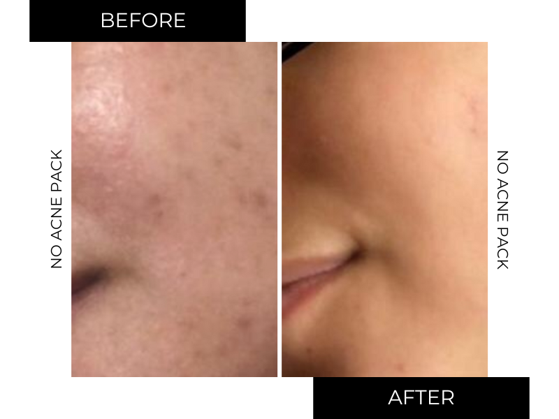 NO-ACNE PACK