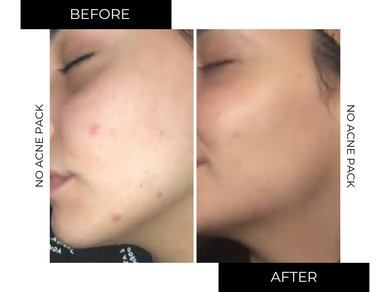 NO-ACNE PACK