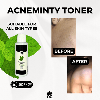 Acneminty toner (120mL)